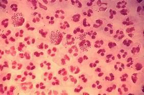 Gonorrhea Dose, Clap, Drip Frequently co-infected with chlamydia Usually asymptomatic