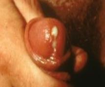 Milky or yellow/green discharge from the penis/vagina, dysuria Bleeding between menstrual