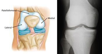 The procedure is an alternative to total knee replacement for patients whose damaged bone and cartilage is limited to the underside of the patella (kneecap) and the channel-like groove in the femur