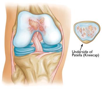 Illustration shows osteoarthritis that is limited to the patellofemoral compartment of the knee. The patella (kneecap) has been removed to show the cartilage damage on the underside.