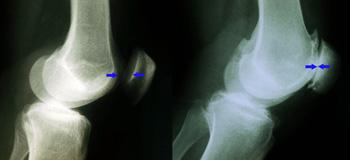 (Right) This x-ray shows narrowed joint space and bone rubbing on bone due to arthritis.