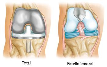 One advantage of patellofemoral replacement over total knee replacement is that healthy parts of the knee are preserved, which helps to maintain more "natural" function of the knee.
