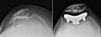 A thin metal component is used to resurface the trochlear groove at the end of the femur. A plastic "button" or cover is used to resurface the backside of the patella.