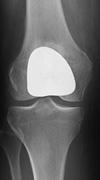 The round plastic patellar implant (right) attaches to the underside of the kneecap. (Left) This x-ray is taken from above the knee.