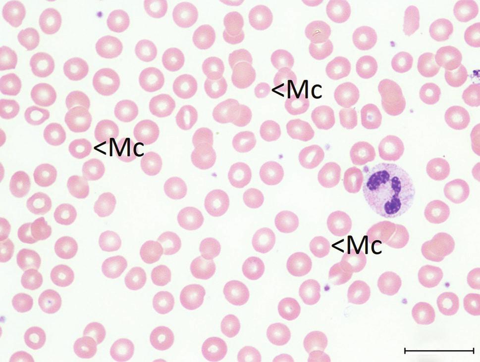 Commentary 1a 1b 1c 1d Fig. 1 Peripheral blood smear images from children with anaemia (Wright s, 100) show (a) microcytic red cells (Mc) from Case 31 with iron (transferrin saturation 2.