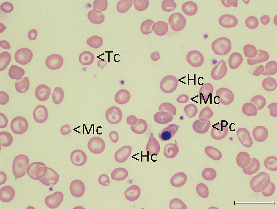 middle (arrow); (c) stomatocytic red cells from Case 29 with single slit (St) and double slits (SSt) characteristic of Southeast Asian ovalocytosis; and (d) severe anisopoikilocytosis from Case 30