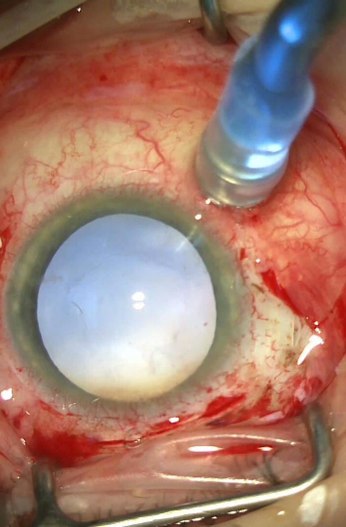 Central or Paracentral Scotoma Associated with Nasal Placement of Chandelier Infusion During Vitrectomy with Fluid-Air Exchange J. Michael Jumper MD, Sara J. Haug MD PhD, Arthur D. Fu MD, Robert N.