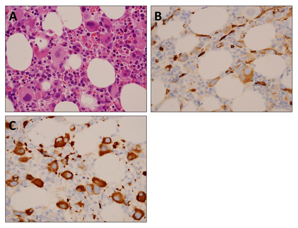 CD34+ Giant Platelets Hematopathology - September 2016 Figure 2: Bone marrow core biopsy findings.