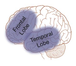 clarify nomenclature Frontotemporal disorders Behavioral variant frontotemporal degeneration (bvftd) Primary progressive aphasia (PPA) Agrammatic/Non-fluent Logopenic Semantic FTD with motor