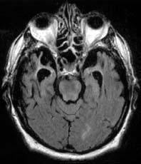 Neuroimaging bvftd Anatomic MRI Anatomic MRI This is the most commonly used FDG-PET Currently