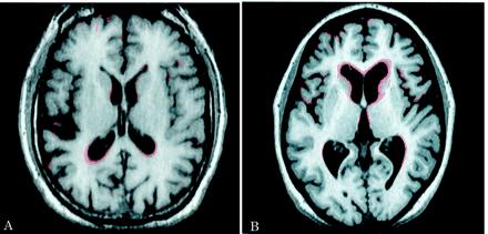 dementia 1 MRI: WM disease Positron emission tomography (PET) of fluorodeoxyglucose (FDG) may