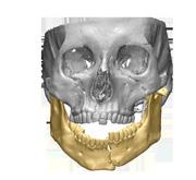 CMF - Products and services 20 PANFACIAL FRACTURES Competitive advantages for a delicate process ORBIT The perfect