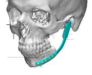 TMJ reconstructions should be adjusted to the millimetre; this is why