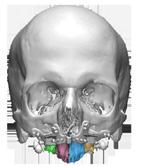 By studying and preparing the virtual osteotomy, identifies the exact