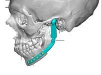 In corrective TMJ surgeries, prostheses should be adjusted to give a
