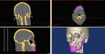 Virtual planning, along with stereolithographic anatomical models, helps the specialist to plan the surgery and thus