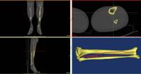 Moreover, the simulation of soft- and hard-tissue deformations allows improved predictability in the intervention.