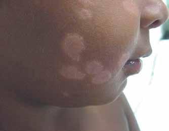 Leprosy among children under 15 years of age: literature review 199 lowed by pain and tactile sensitivity. These are shaped by alopecia, hypo, and anhydrous areas.
