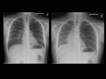 Inspiratory Expiratory Chest Xrays in Foreign Bodies A. Martinot et al.