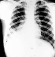 400 Dikensoy, Usalan, Filiz Box 1: Case report of a long retained tracheobronchial foreign body A previously healthy, 15 year old boy was admitted to our hospital with a one year history of recurrent