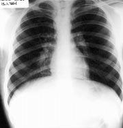 Foreign body aspiration 401 Figure 3 Control chest radiograph showing complete resolution of the previous middle lobe atelectasis, and also right hilar enlargement.