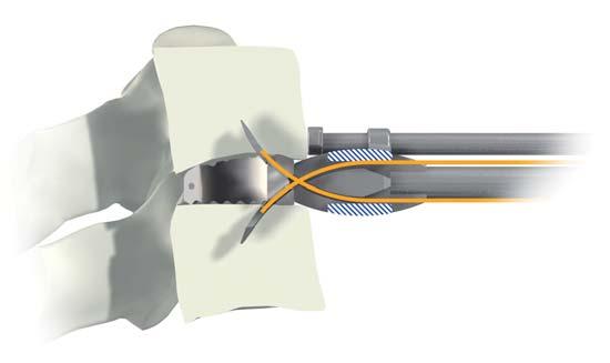 SURGICAL TECHNIQUE ROI-C TM 9b Insertion of the second half anchoring plate The second half anchoring