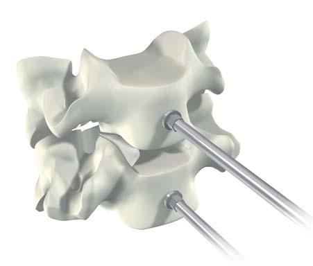 vertebral surgery.