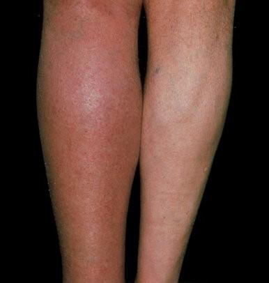 Physical Exam Body mass index Venous insufficiency and Sleep Apnea Distribution of the edema Unilateral due to local cause DVT, Venous, lymphedema Bilateral: