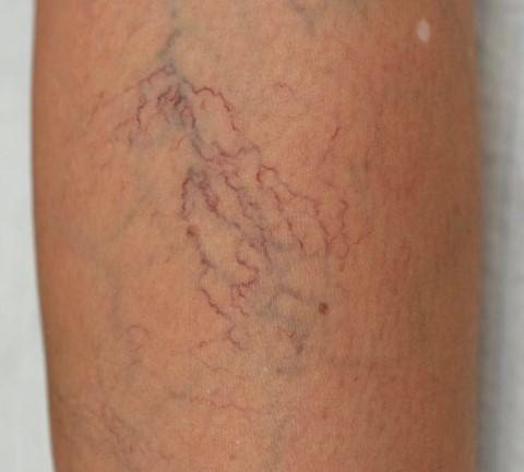 Brown hemosiderin discoloration (venous) Warty texture and induration