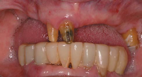 S62 Clinical Implant Dentistry and Related Research, Volume 7, Supplement 1, 2005 lous crest was exposed through a midcrestal incision.