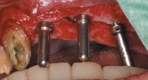 85 mm and a Mk IV fixture or a Replace Select Tapered implant with reduced drilling depth of final burr (Nobel Biocare AB) were preferred.