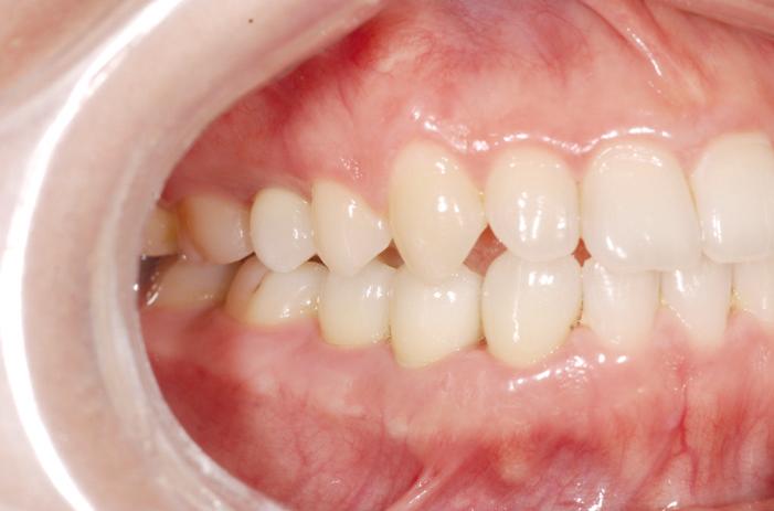 Zirconia abutments were milled and definitive prostheses with canine guided occlusion were made with IPS- Empress II system.