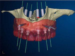 Guided immediate loading implant surgery planned with Implant St