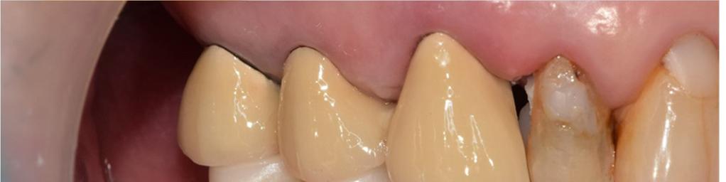 Zirconia Crowns on the Right Side