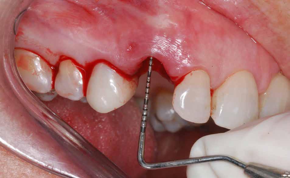 The depth from the free gingival margin