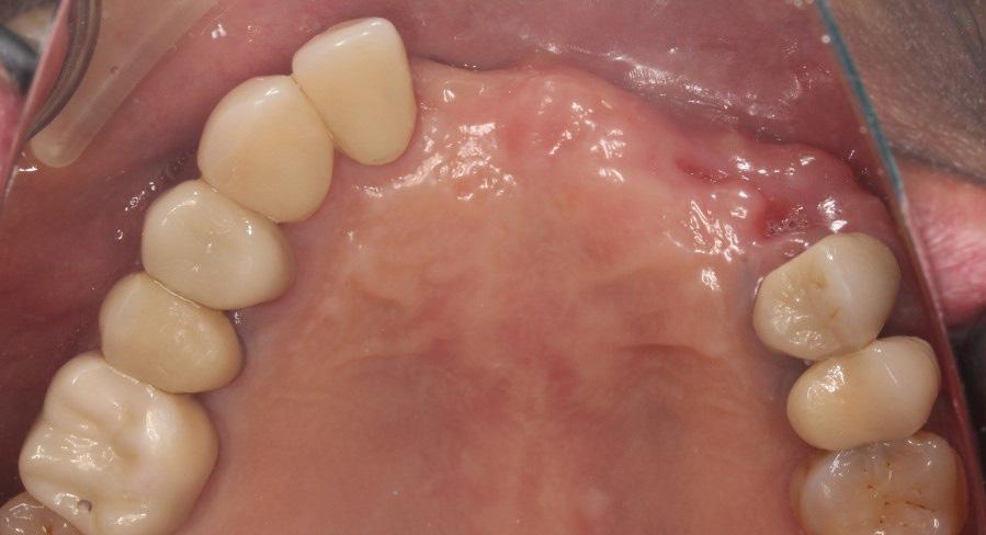 Second, an implant restoration for the replacement of the edentulous space at teeth #13, #11, #21 and #22 was determined to be the more conservative option.