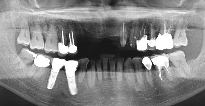 2 Pre-operation, Cross-sectional shows bone available at the implant site Fig.
