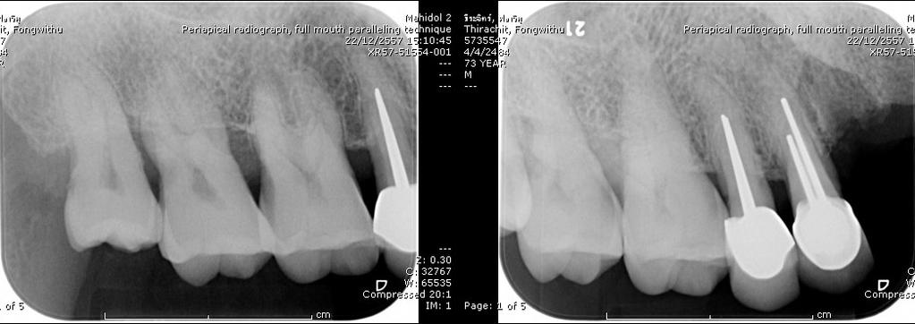 The occlusion on the right and left side showed an unclassified molar relationship due to the missing tooth (Fig 3, 4). The SAC classification for implant dentistry was used.