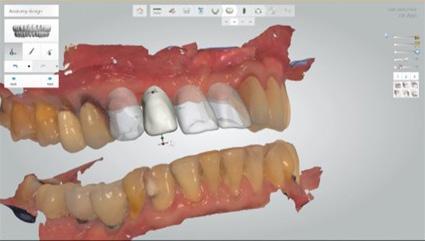 Fig.5 Bone at the edentulous area The patient was scanned using an intraoral scanner (TRIOS, 3Shape).