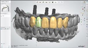 Summary During the restorative phase, an impression was taken at implant level according to protocol.