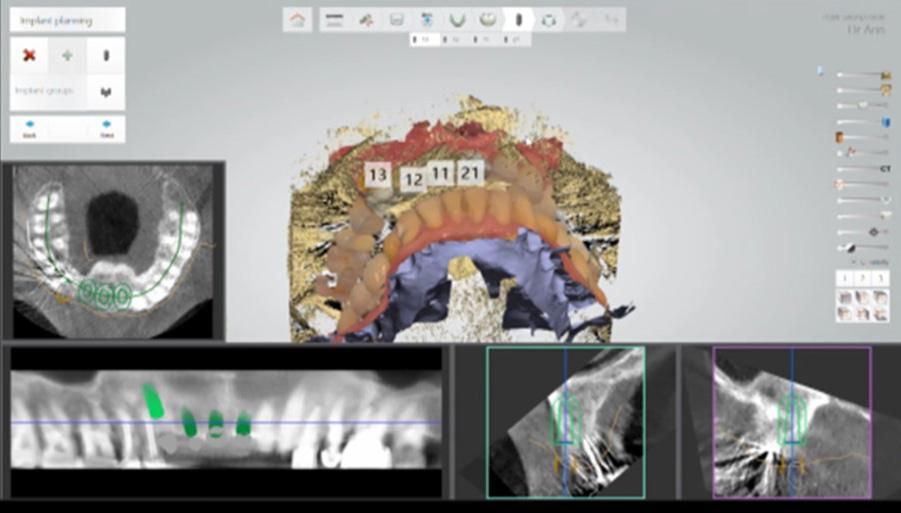8 Cone beam (CBCT) and intraoral (3Shape, TRIOS) 3D digital impression files merged in software to create
