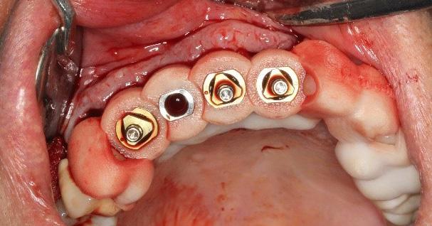 the optimum location for implant placement.