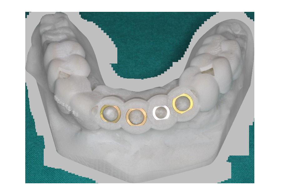 Using a prosthetic-driven workflow (3Shape Implant Studio) by first placing virtual crowns, helped to ensure proper depths and angulations.