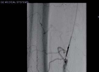 Locate Correct positioning and orientation of the nitinol cannula towards the true lumen at the right location is straightforward with the highly