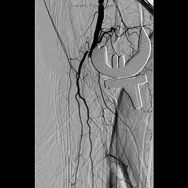 op yr ig ht H M P om m un ic at io n s ASE REPORT Figure 5. Right popliteal artery occlusion (right lateral view on angiogram).