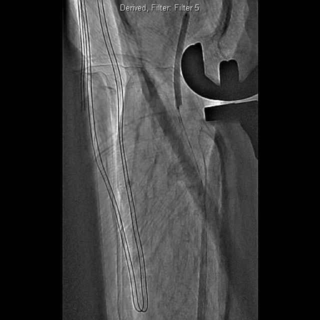The patient underwent successful right total knee arthroplasty (TKA) in June 2014. She developed DVT in the right lower extremity despite being on warfarin.