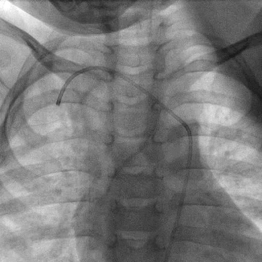ps1 ps2 One major aortopulmonary collateral artery from subclavian artery