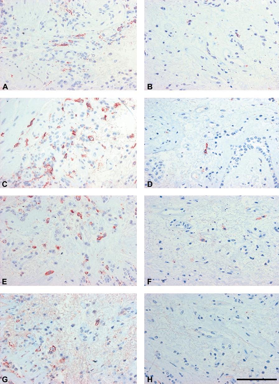 Immunohistochemical staining of bronchial biopsy specimens before (left) and after (right) 16 weeks of omalizumab treatment.