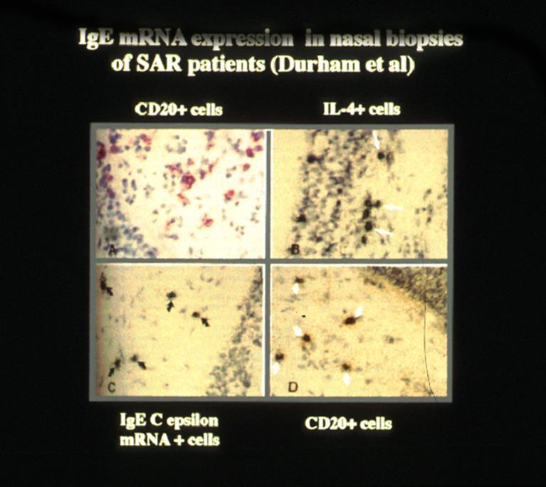 IgE is locally produced in the target organ CD2+