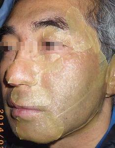 1 day Face burn : 0 day covered by hydrocolloid film White exudates were observed. Infection? No!